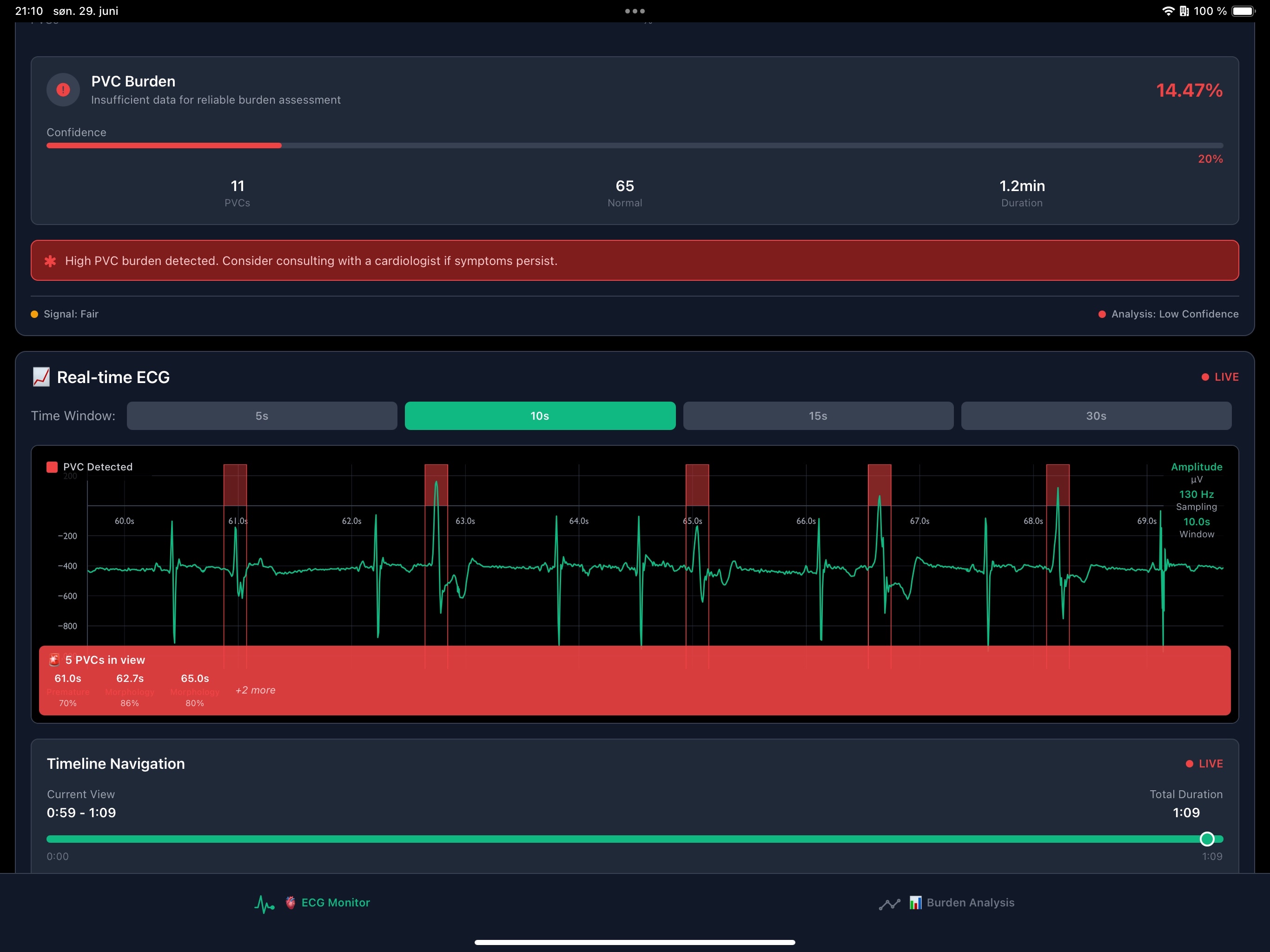 Polar H10 ECG Arrhythmia Detector